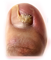 Candidiasis of skin and nails